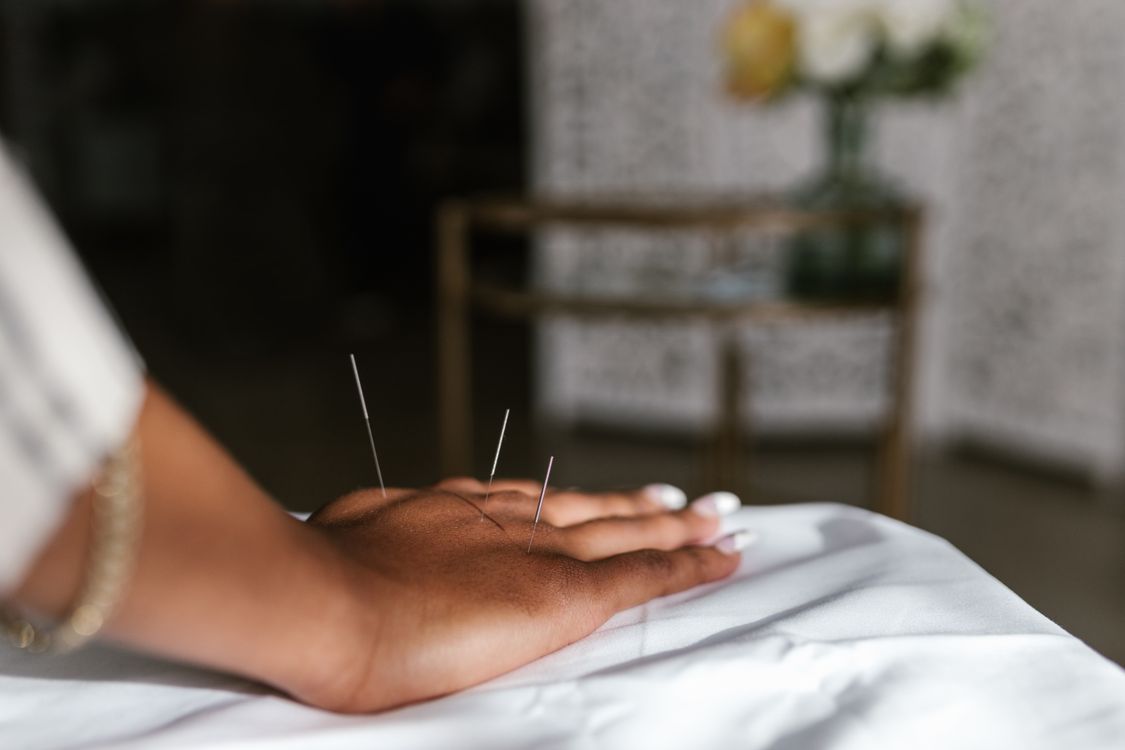 Acupuncture treatment, part of holistic care in the building
