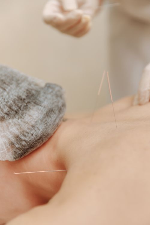 Acupuncture treatment on shoulder and neck