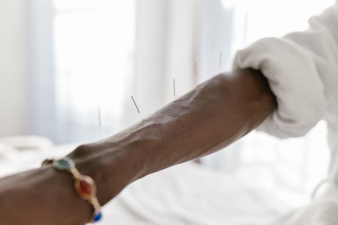Calm acupuncture treatment on forearm
